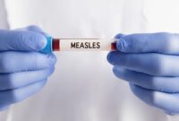 Ilustrasi campak (Foto: Getty Images/anilakkus)